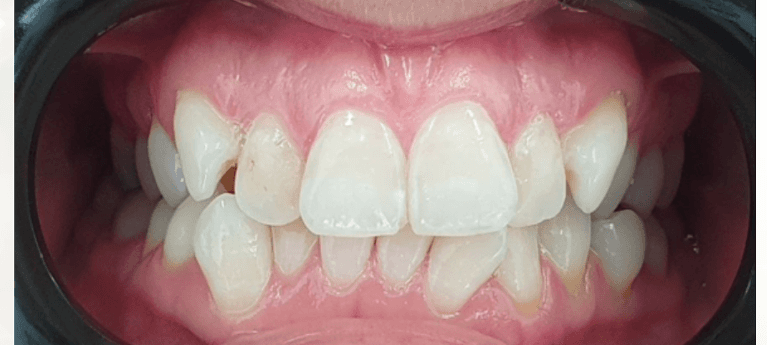 teeth straightening Invisalign before