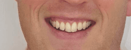 Before clear aligner of Invisalign