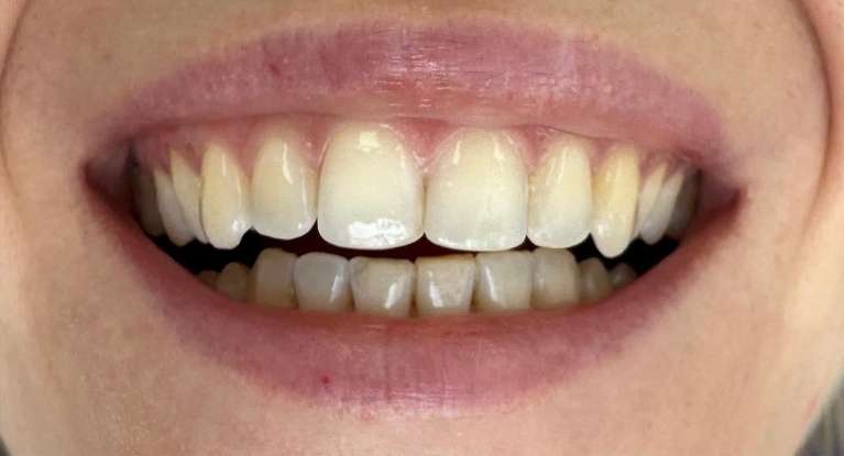 Yellow teeth treatment: before image