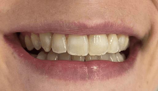 Treatment to improve smile: before image