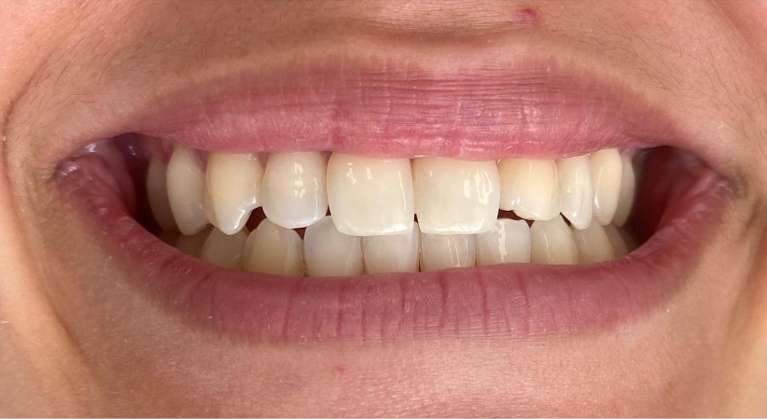 Brighter smile teeth whitening: before treatment