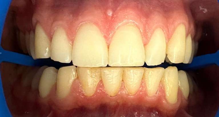 Brightest-smile-after-zoom-whitening-Before-Image