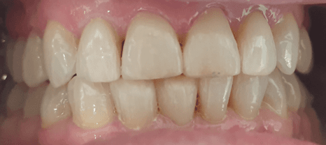 Resin veneers before and after: before image
