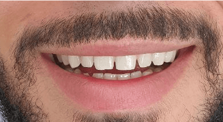 Composite veneers before and after: before image