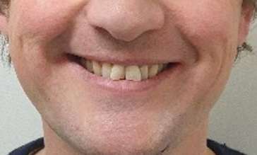 before invisalign
