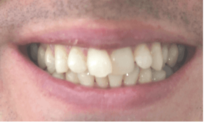 Invisalign teeth straightening: before image