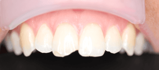 Dental fix for chipped tooth: before image