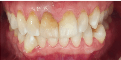 Single tooth veneer: Before treatment