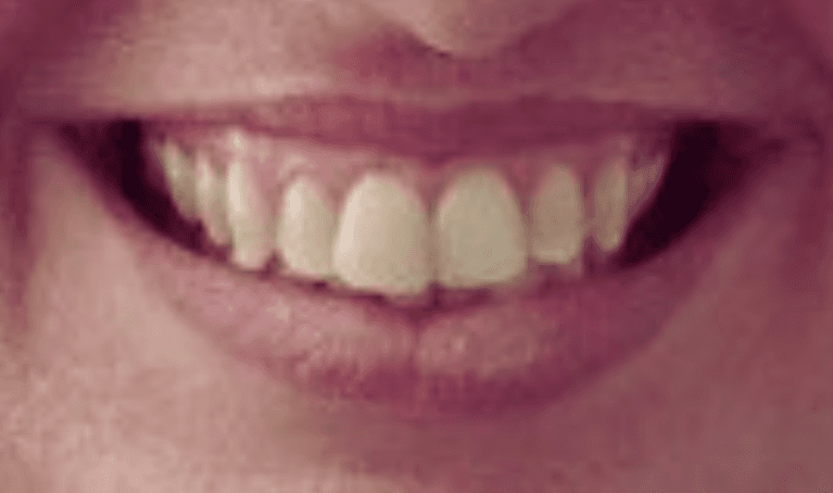 Teeth alignments with Invisalign before