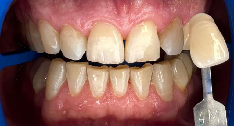 Amazing-teeth-whitening-results-from-one-session-of-Zoom-Whitening-Before-Image