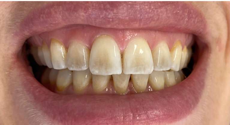 In chair teeth whitening before and after: before image