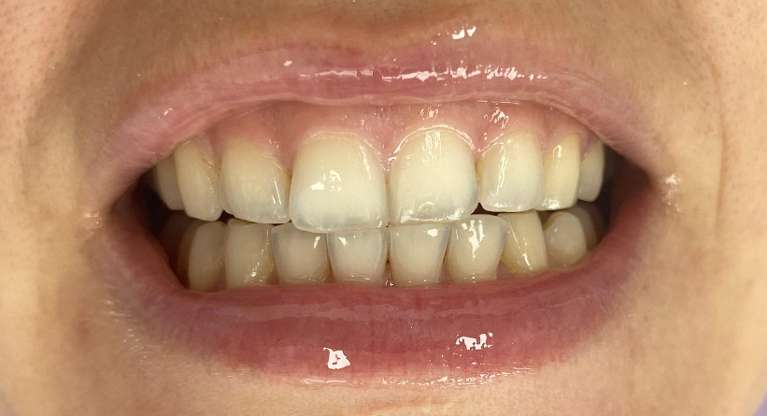 Philips zoom in chair whitening: before treatment