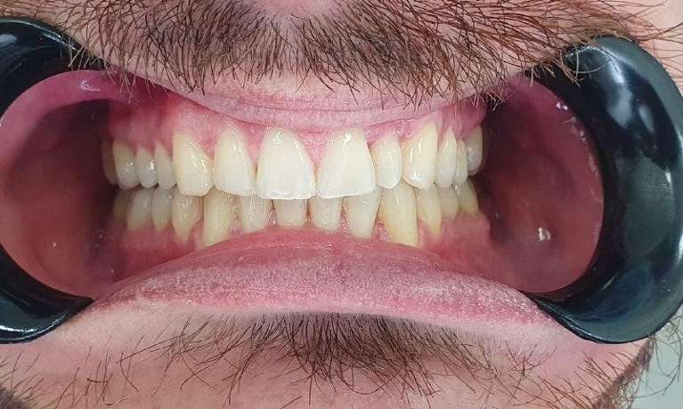 Teeth correction by veneers: before image
