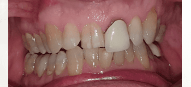 Natural-look-dental-crown-Before-Image