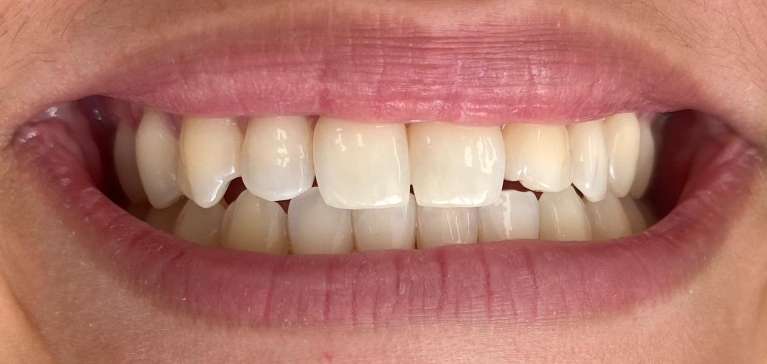 Teeth whitening one session: before treatment