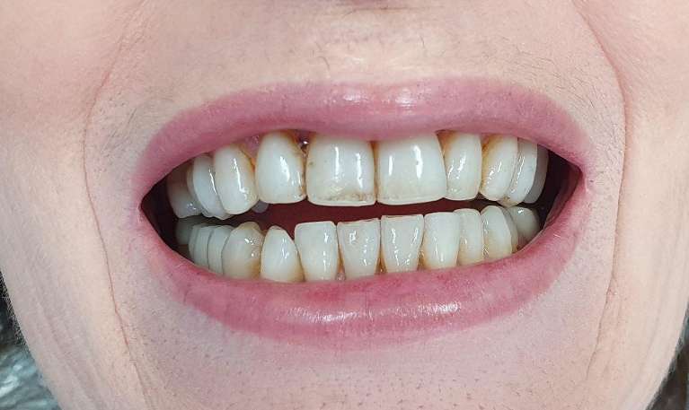 Porcelain veneers before and after: Before image
