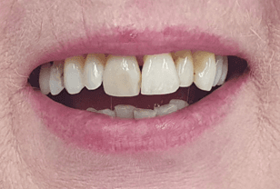 Benefits of porcelain veneers: Before image