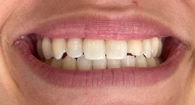 Resin bonding teeth: before image