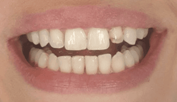 Natural looking veneers: Before treatment