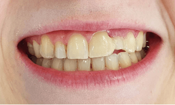 Single veneer treatment: Before image