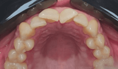Invisalign for crowded teeth: before image