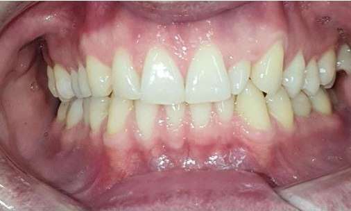 Invisalign teeth straighteners: Before image