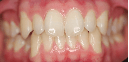 Invisalign for teeth: Before straightening treatment