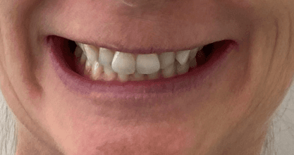 Invisalign teeth alignment: before image