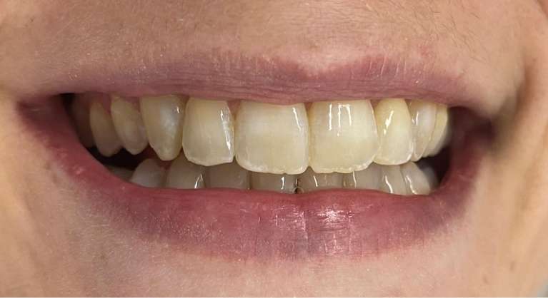 Teeth whitening: before treatment