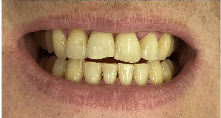Before teeth whitening