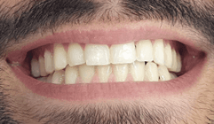 Treatment for whiter smile: before image