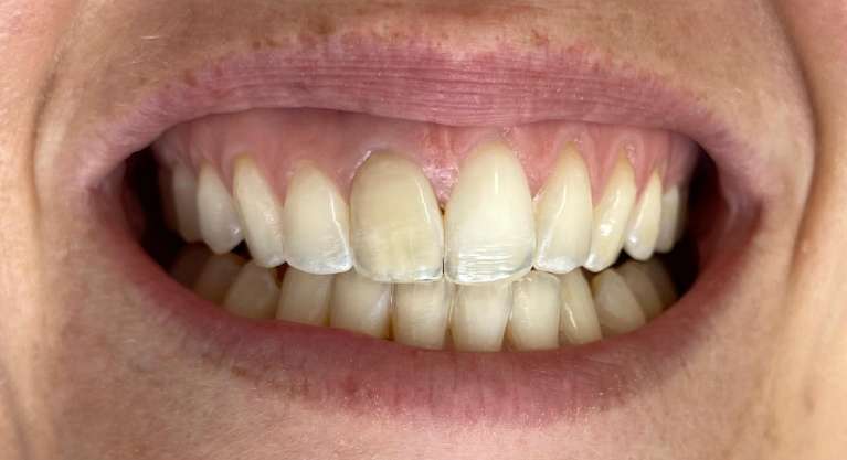 Zoom whitening before and after: before image