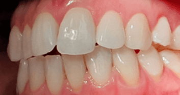 Invisalign aligners treatment: Close-up before image