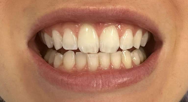 Dental treatment before wedding: Close-up before image