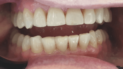 Resin veneers before and after: close-up before image
