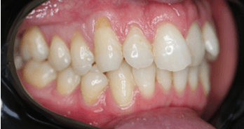 Invisalign teeth straightening: close-up before image