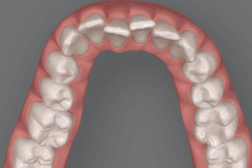 Graphic illustration of crowded teeth treatment: before image