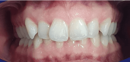 Invisalign teeth alignment: close-up before image