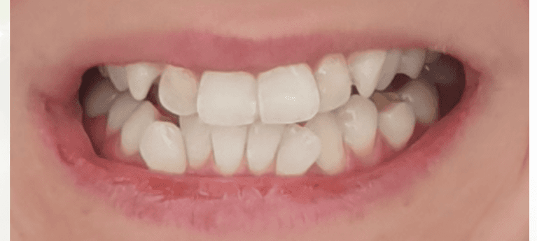 misaligned teeth